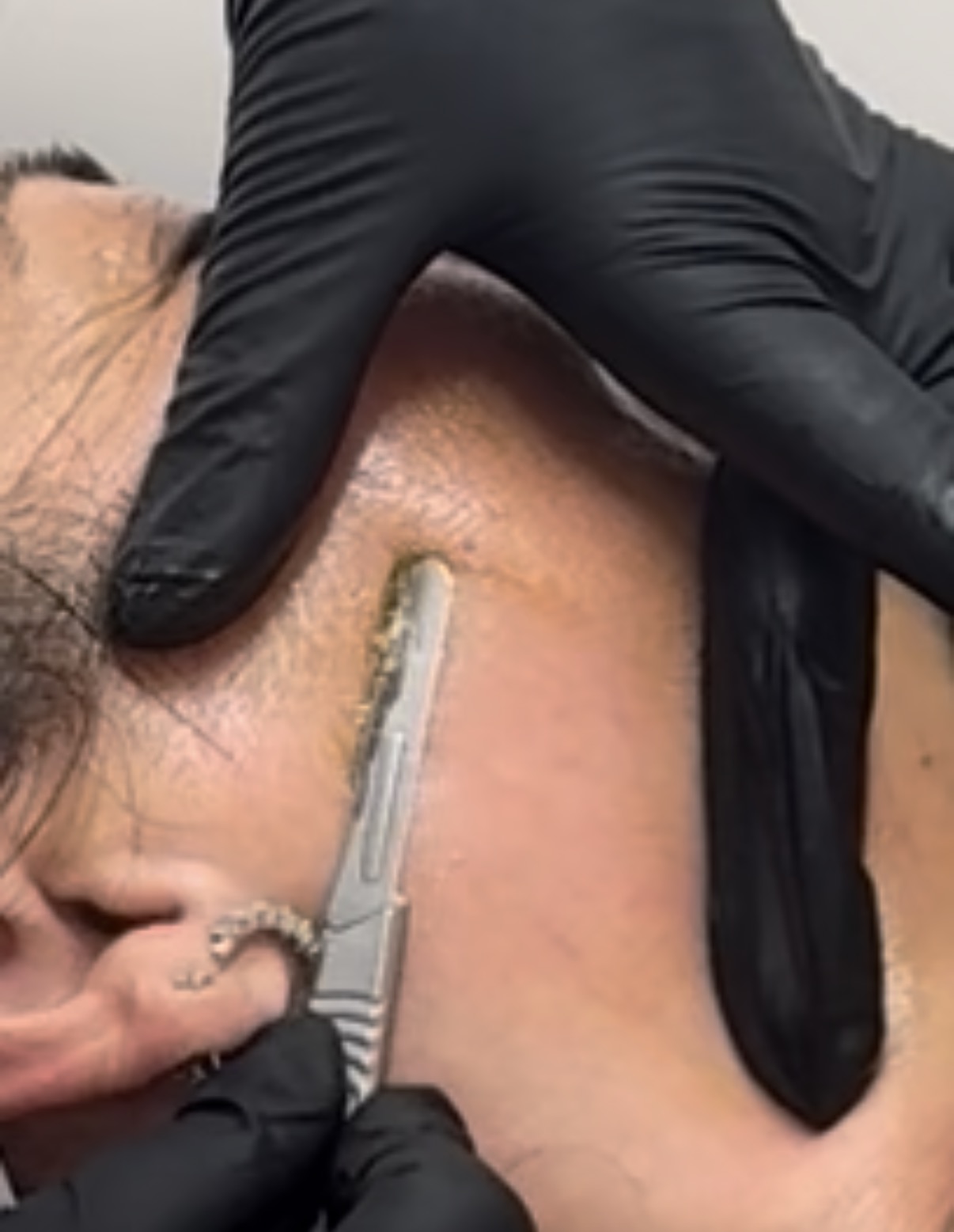 Dermaplaning treatment